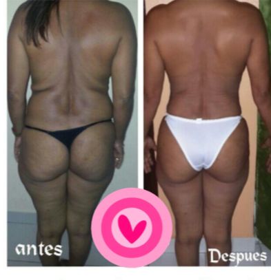 Resultado real de tratamiento estético, vista comparativa